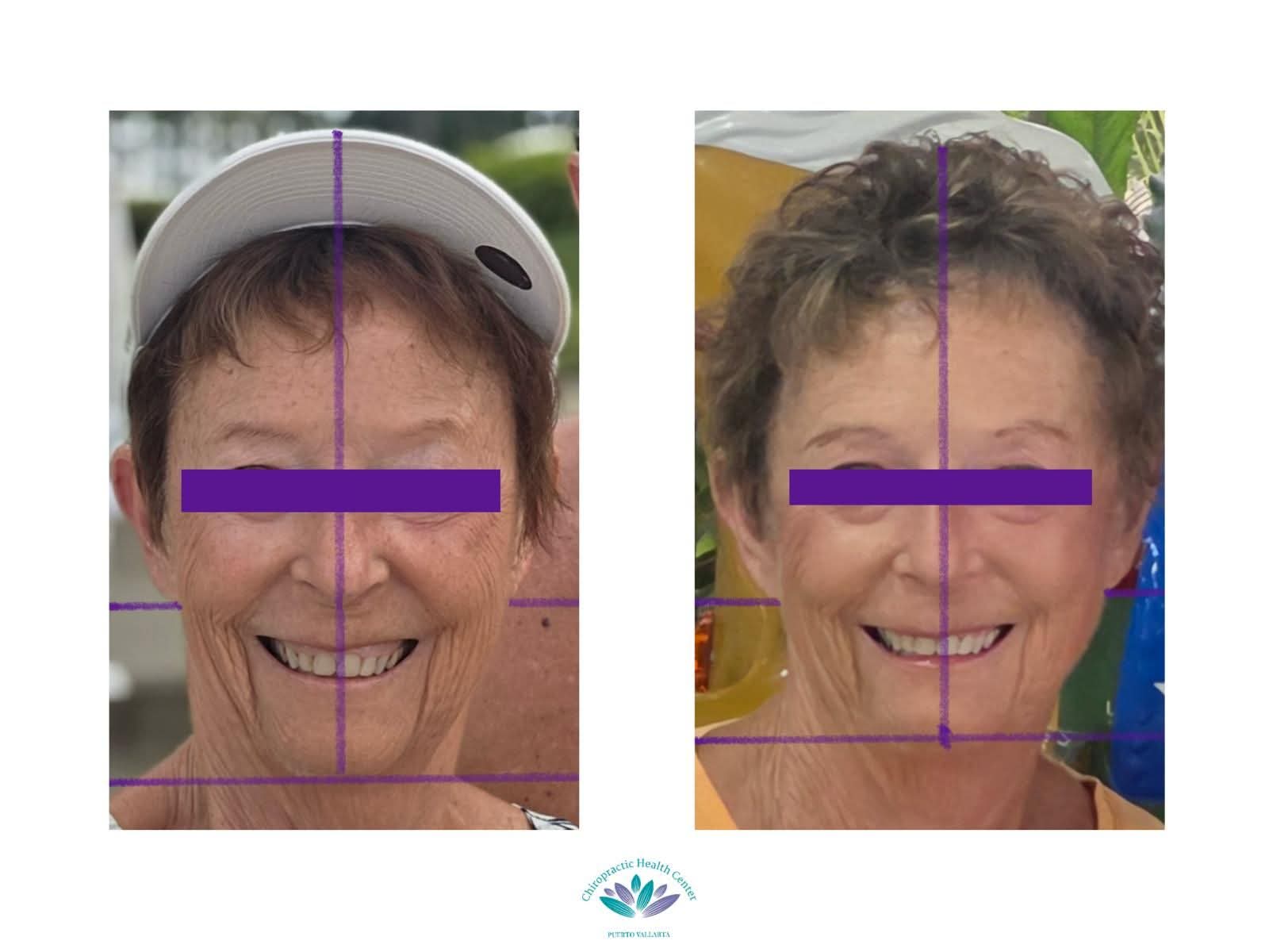 Before and after comparison showing improved facial symmetry following cranial adjusting